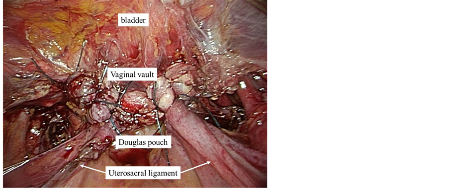 Severe Pelvic Organ Prolapse with Large Vaginal Mucosal Defect