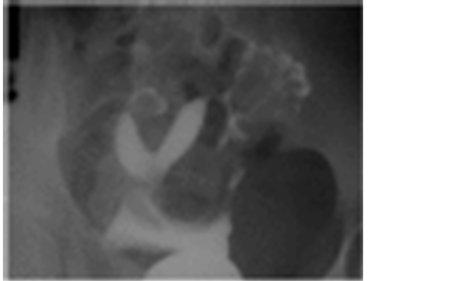Single horn uterus