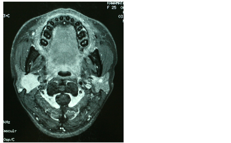 A Case Of Pleomorphic Adenoma Of The Parotid Gland With Multiple Local