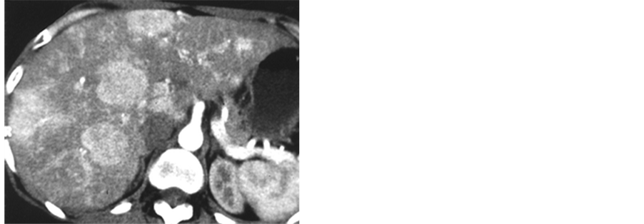 Atypical Ct And Mri Features Of Focal Nodular Hyperplasia Of Liver A