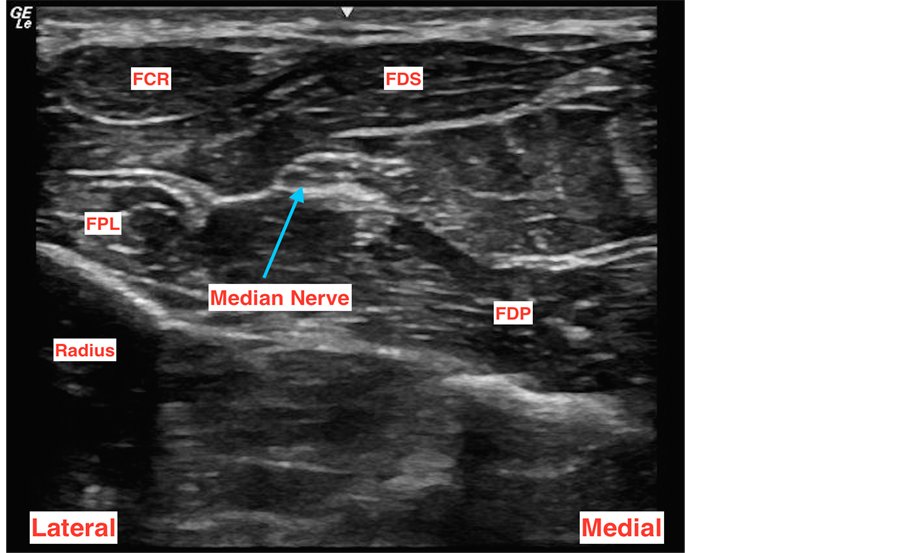 Targeted Ultrasound-Guided Double Catheters (Infraclavicular-Brachial
