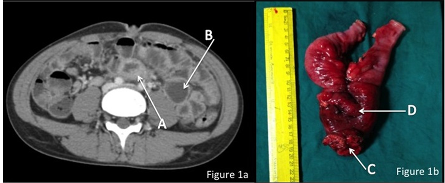 Post-Traumatic Long Segment Small Bowel Stricture —A Diagnostic Dilemma