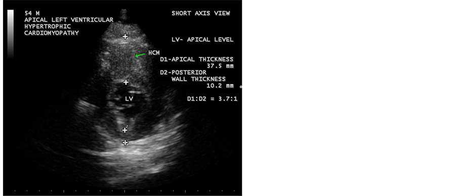 Apical Left Ventricular Hypertrophic Cardiomyopathy: A Case Report