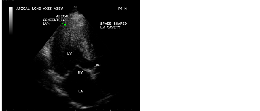 Apical Left Ventricular Hypertrophic Cardiomyopathy: A Case Report
