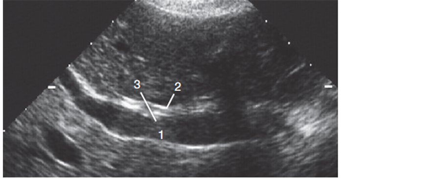 The Accuracy of Transabdominal Ultrasound in Detection of the Common ...