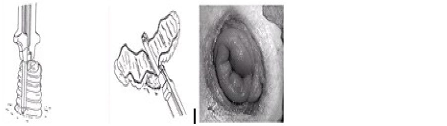 Intestinal Stoma Prolapse And Surgical Treatments Of This Condition In 
