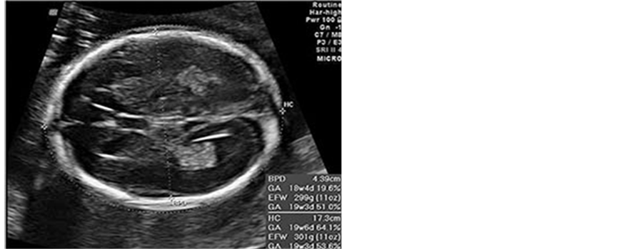 Sonographic Evaluation of Normal Anatomy of Fetal Central Nervous