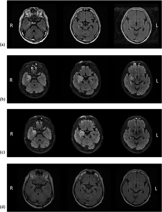 Case Study on Focal Retrograde Amnesia due to Limbic Encephalitis