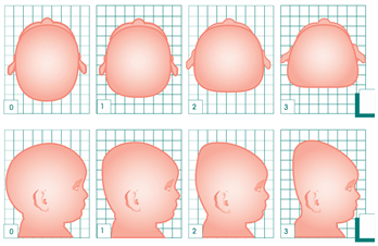 Cranial Asymmetry