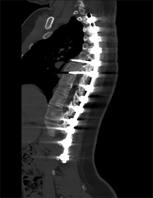 In hoeveelheid vuist Gangster Radiological Evaluation of Spinal Instrumentation as Treatment for  Adolescent Idiopathic Scoliosis, a Single Saudi Center 5-Year Experience