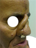 Forehead Flap in Coverage of Nasal Defects: Our Experience