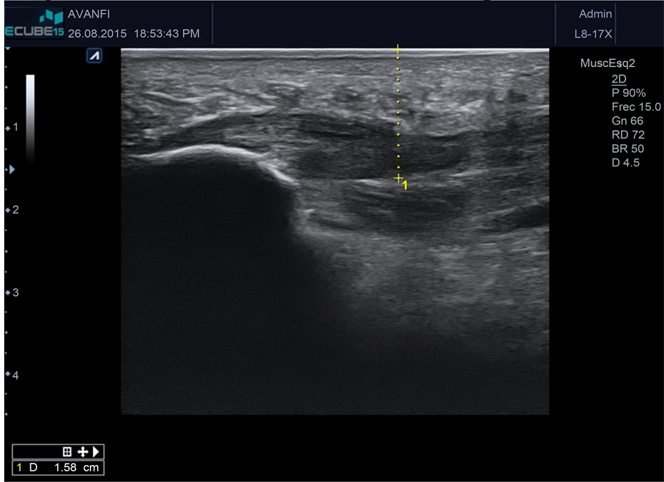 Ultrasound-Guided Plantar Fascia Release with Needle: A Novel Surgical