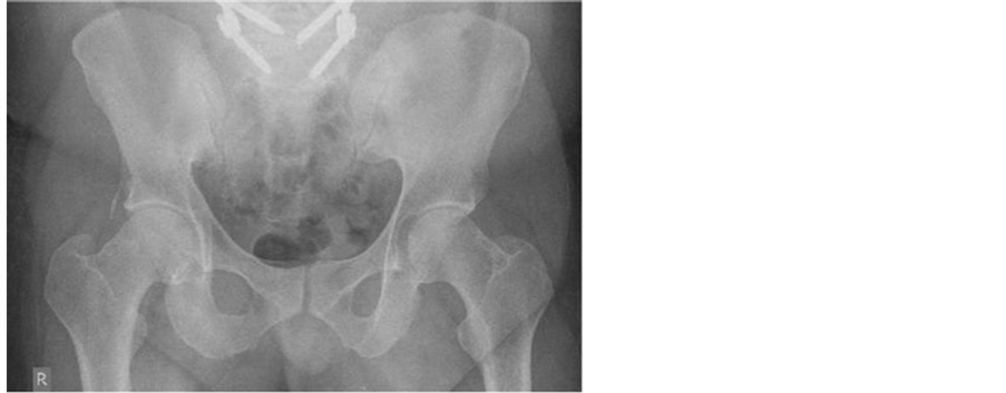 normal hip xray with pain and weakness