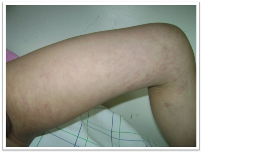 Klippel Trenaunay Syndrome A Rare Cause Of Vaginal Bleeding In The