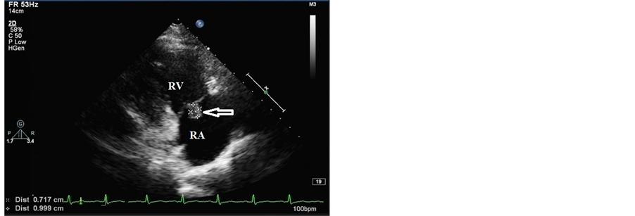 Ischemic Stroke Revealing Infective Endocarditis in a Young Subject: About  a Clinical Case