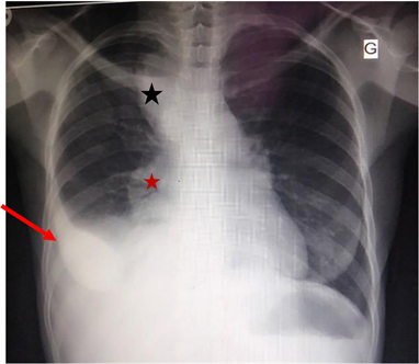 Interest of Systematic Chest Radiography during Periodic Medical Visits ...