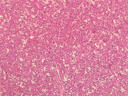 Testicular Burkitt’s Lymphoma: A Case Report and Literature Review