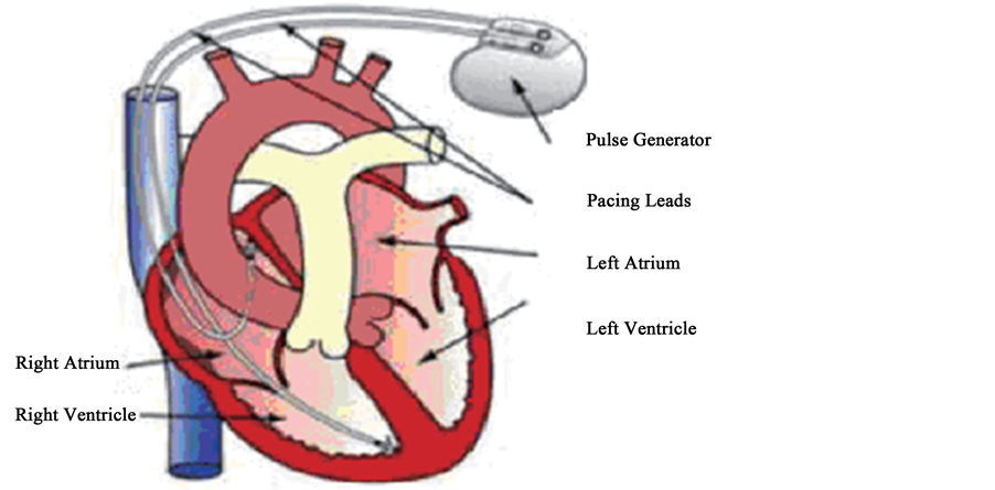 Fuzzy Controller for Dual Sensors Cardiac Pacemaker System in Patients ...