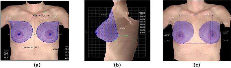 Breast Asymmetry Evaluation Using Objective Measures after Breast