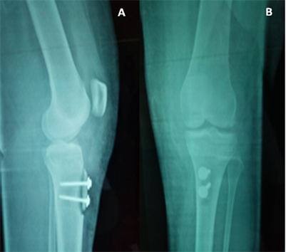 tibial tubercle osteotomy