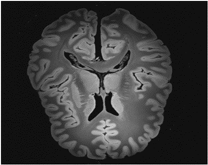 Edge U-Net: Brain tumor segmentation using MRI based on deep U-Net