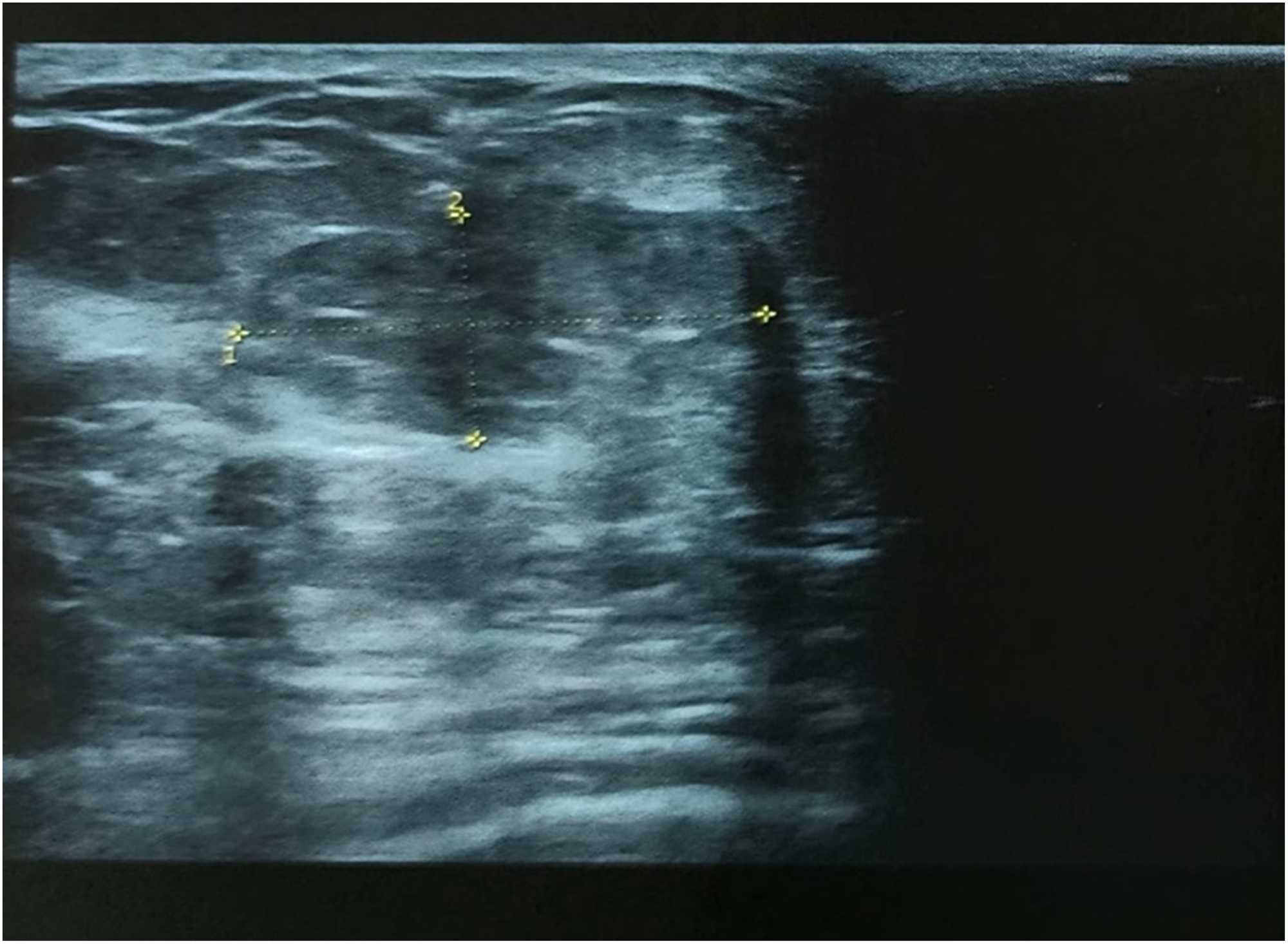 Mucinous Colloid Carcinoma of the Breast: A Case Report