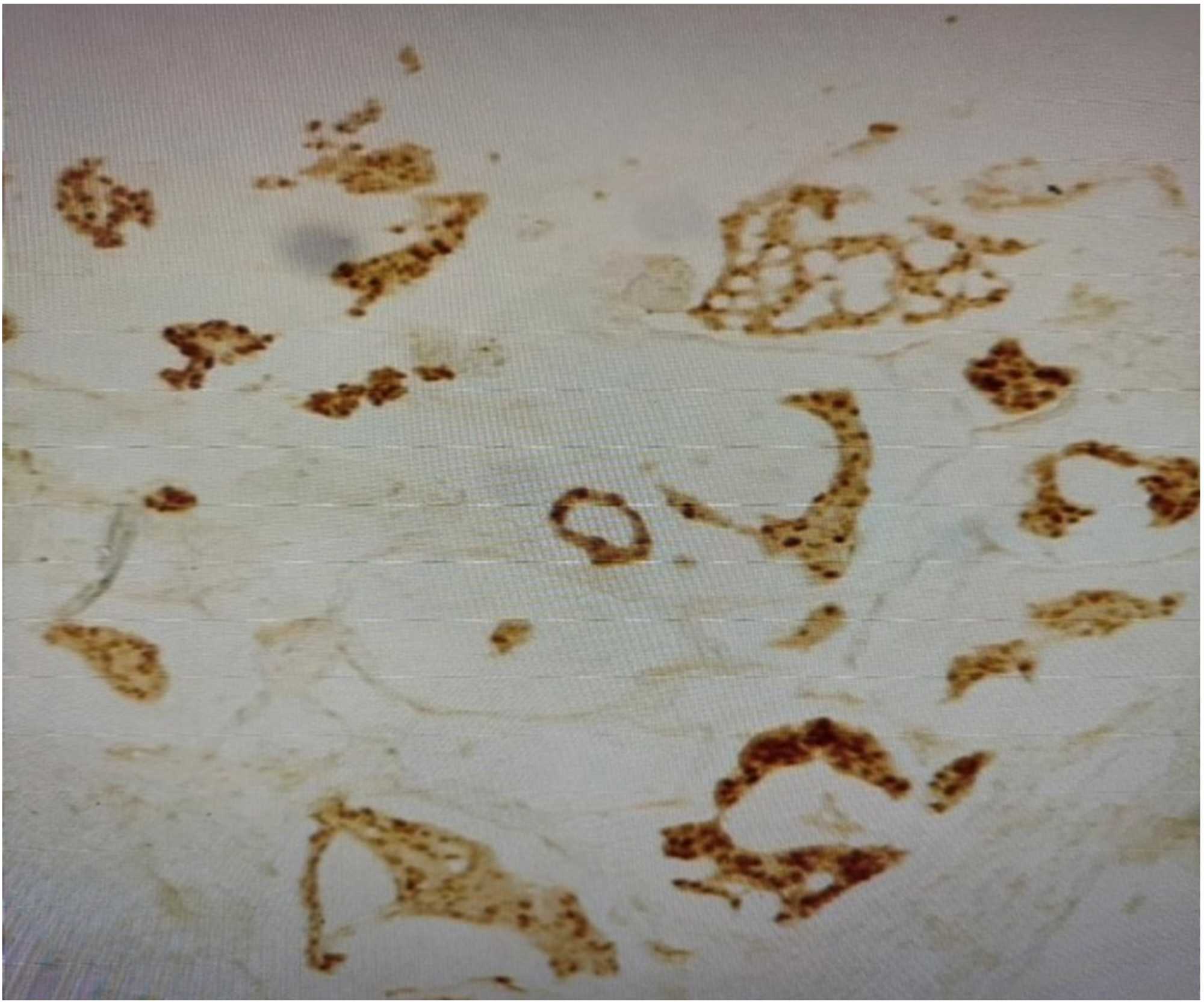 Mucinous Colloid Carcinoma of the Breast: A Case Report
