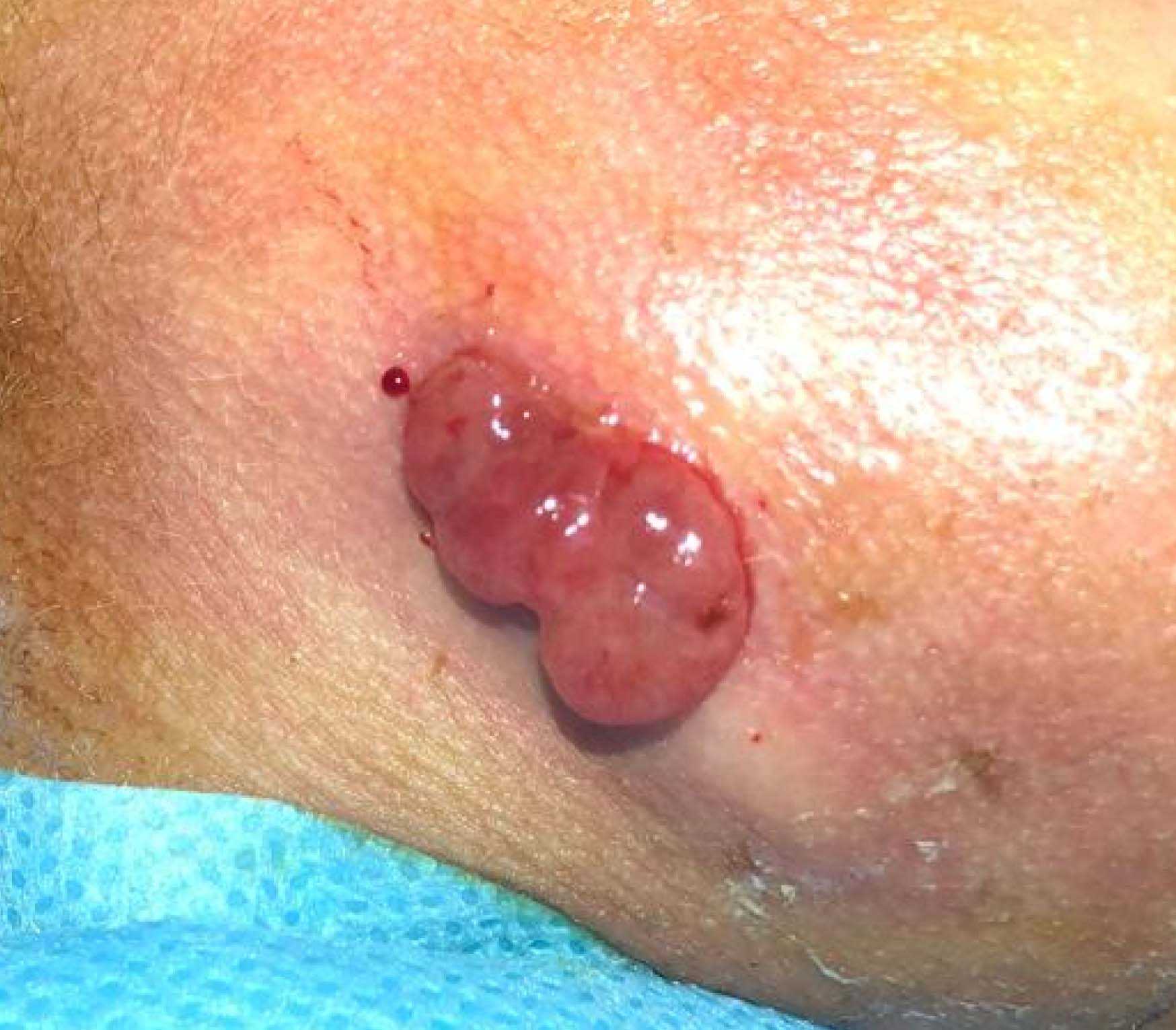 Skull Base–related Lesions at Routine Head CT from the Emergency  Department: Pearls, Pitfalls, and Lessons Learned | RadioGraphics, image size:1748x1531