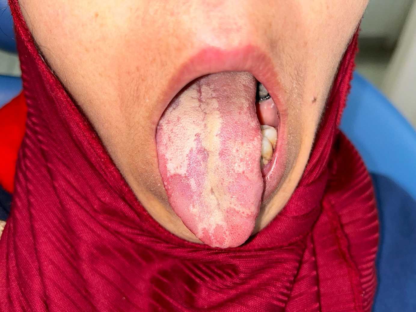 Woman Halitosis Candida Albicans Pointing Her Tongue — Stock Photo © sruilk  #360297564, image size:1384x1040