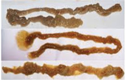 Newly Discovered Rope Worm Infections: First Case Report in Gulf