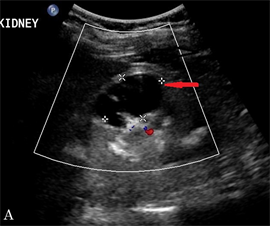 renal cyst ultrasound