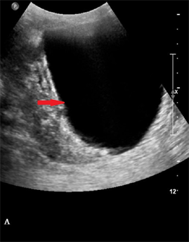 renal cyst ultrasound