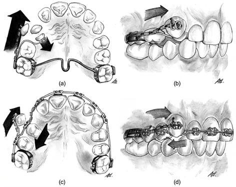 A multidisciplinary treatment approach of complete transposition of  impacted maxillary left canine with maxillary first premolar in presence of  bilateral congenital absence of maxillary lateral incisors - APOS Trends in  Orthodontics