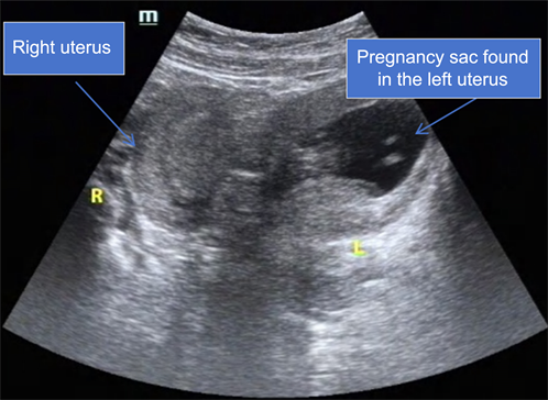 A Rare Case Report of Uterine Didelphys, in Which One Uterus Carried a