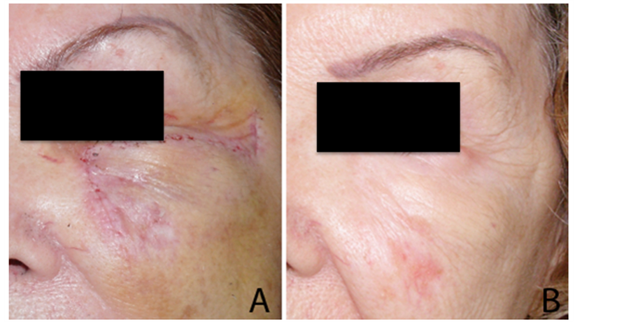 Evolution of Post Surgical Scars Treated with Pure Rosehip Seed Oil