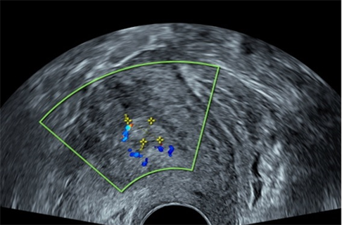 Endometrial Evaluation by Transvaginal Ultrasonography Saline Infusion  Sonohysterography, Hysteroscopy versus Endometrial Office Bipsy in  Perimenopausal Bleeding: A Comparative Study
