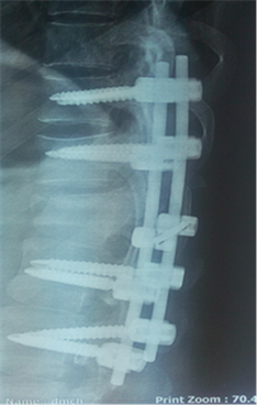 Outcome of Long Segment Transpedicular Screw Fixation in Unstable  Thoracolumbar Spine Injury with Incomplete Neurological Deficit