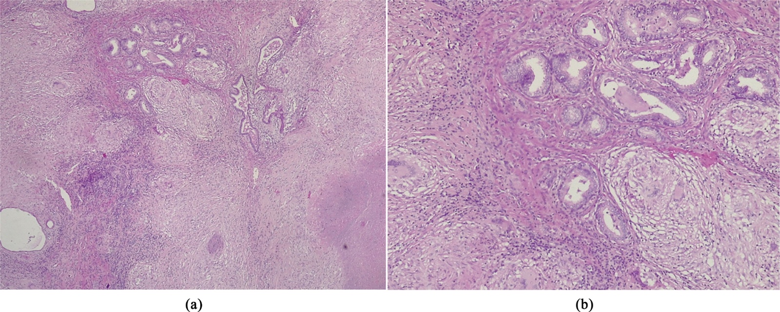 Tuberculosis of the Prostate: A Case Report