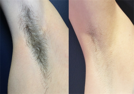 Are Dental Implants Right For You_