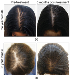 Combination Therapy to Treat Asian Female Pattern Hair Loss