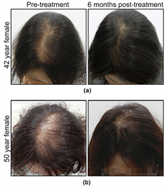 Combination Therapy to Treat Asian Female Pattern Hair Loss