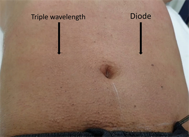 Triple Wavelength and 810 nm Diode Lasers for Hair Removal: A Clinical and  in Silico Comparative Study on Indian Skin