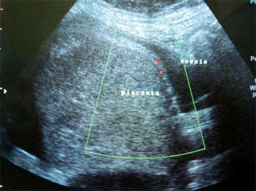 Placenta Accreta: Causes, Risks, Diagnosis, and Treatment Options