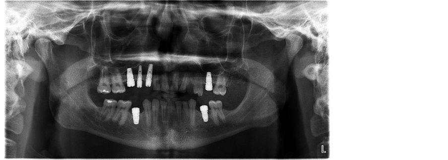 Success Rate Of Dental Implants Placed In The Atrophic Posterior