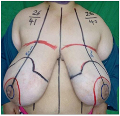 Upper Footprint Dependent Nipple Position to Avoid High-Riding Nipple after  Reduction Mammoplasty