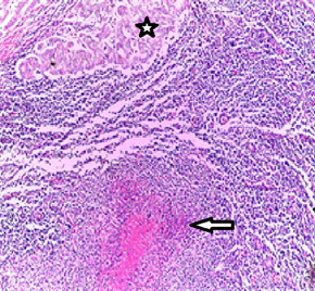 Anatomo-Clinical Case: Coexistence of Tuberculosis with Axillary Lymph