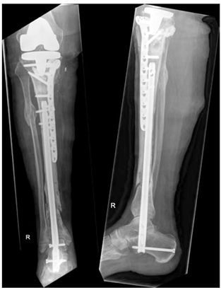 Ankle Arthrodesis Nail Combined with Locking Compression Plate to Stabilize  Two-Level Pathologic Tibial Fractures