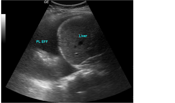 pleural effusion ultrasound