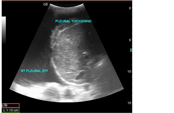 pleural effusion ultrasound