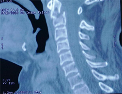pt and ot after odontoid fracture